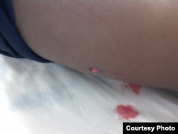 detalle del disparo a la espalda a Raidel Vidal Caignet, de 27 años de edad, en Mayarí, Holguín, Cuba, el 23 de enero de 2019.