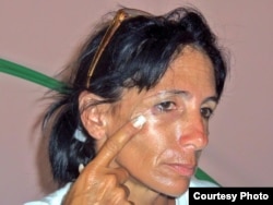 Leticia Ramos Herrería muestra golpes recibidos ayer 3 de noviembre